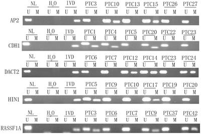 Intratumor Epigenetic Heterogeneity—A Panel Gene Methylation Study in Thyroid Cancer